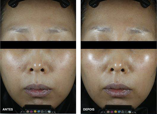 Resultados do tratamento na face